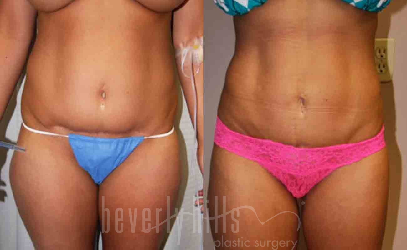 Tummy Tuck Patient 06 Before & After