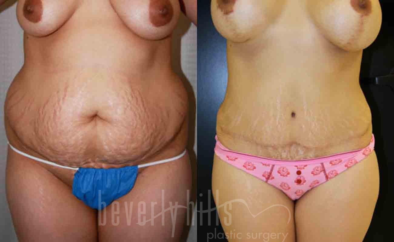 Tummy Tuck Patient 07 Before & After