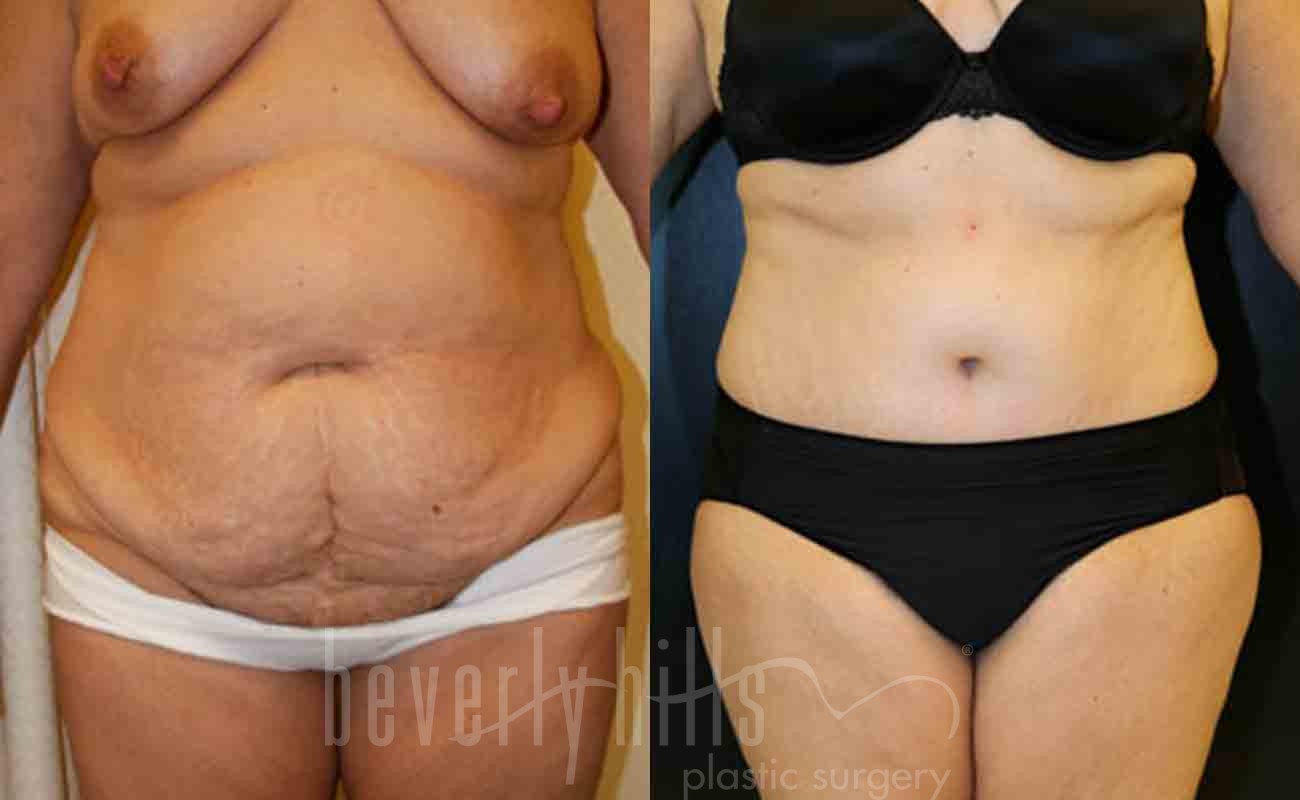 Tummy Tuck Patient 08 Before & After