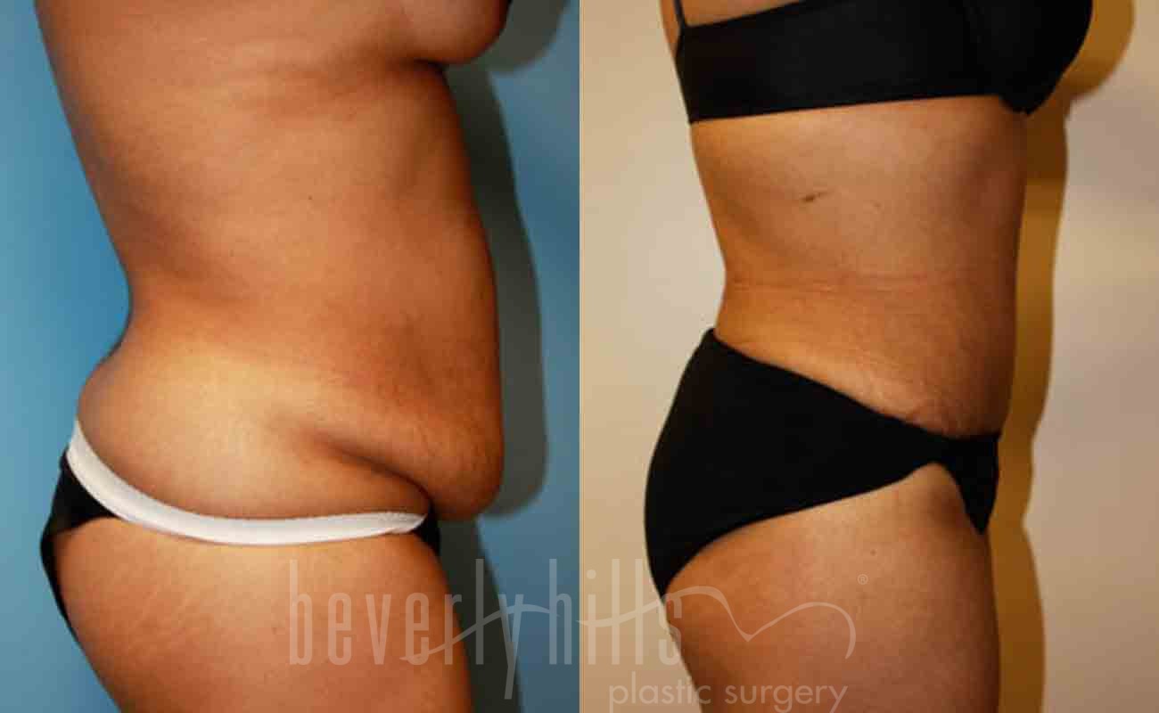 Tummy Tuck Patient 09 Before & After