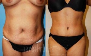 Tummy Tuck Patient 09 Before & After - Thumbnail