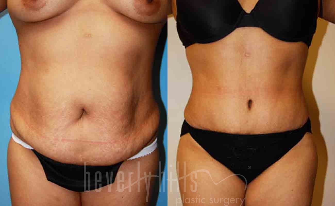 Tummy Tuck Patient 09 Before & After