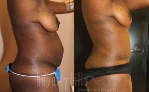 Tummy Tuck Patient 10 Before & After - Thumbnail