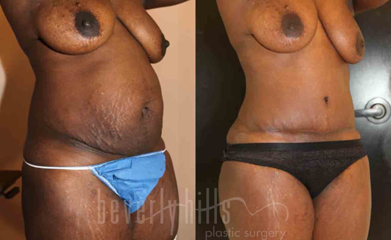 Tummy Tuck Patient 10 Before & After