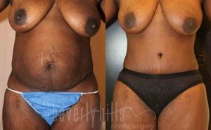 Tummy Tuck Patient 10 Before & After - Thumbnail