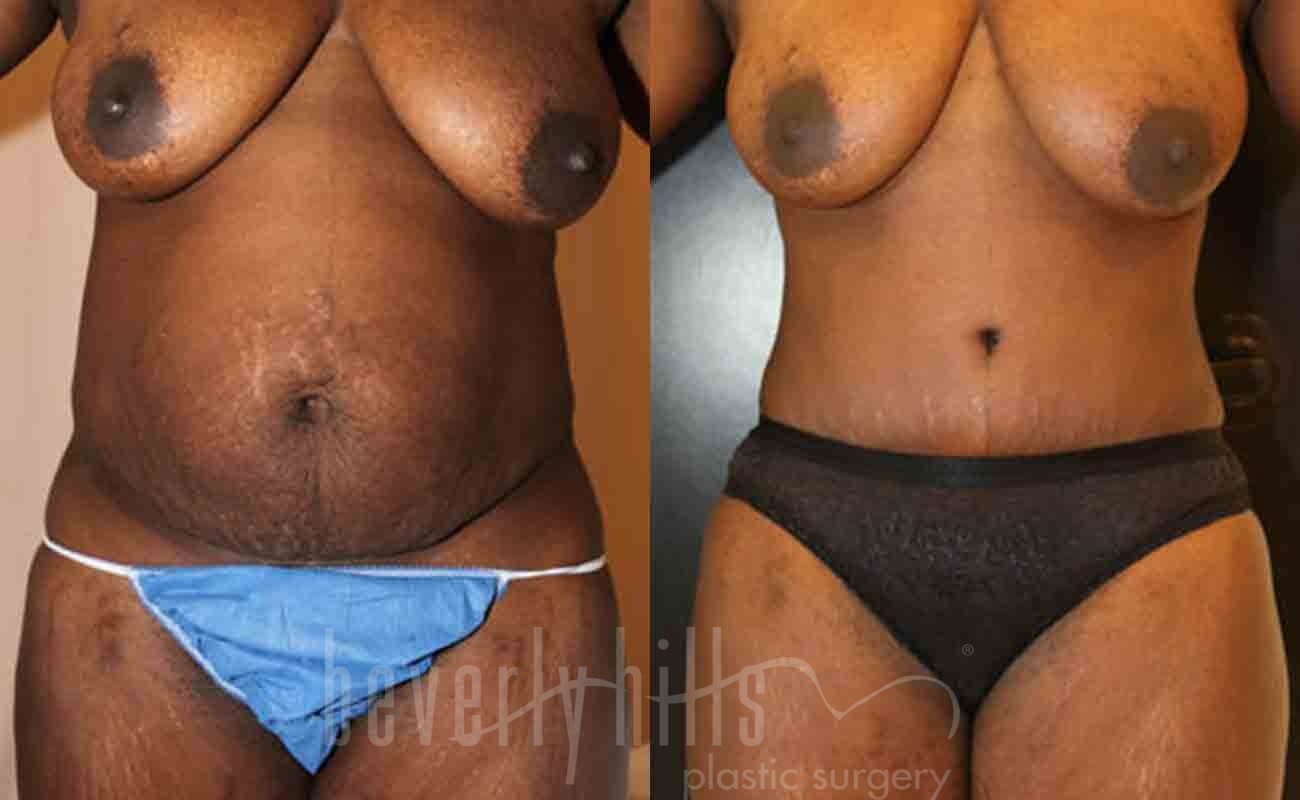 Tummy Tuck Patient 10 Before & After