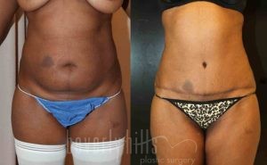 Tummy Tuck Patient 11 Before & After - Thumbnail