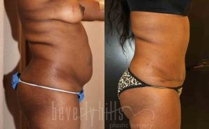 Tummy Tuck Patient 11 Before & After - Thumbnail