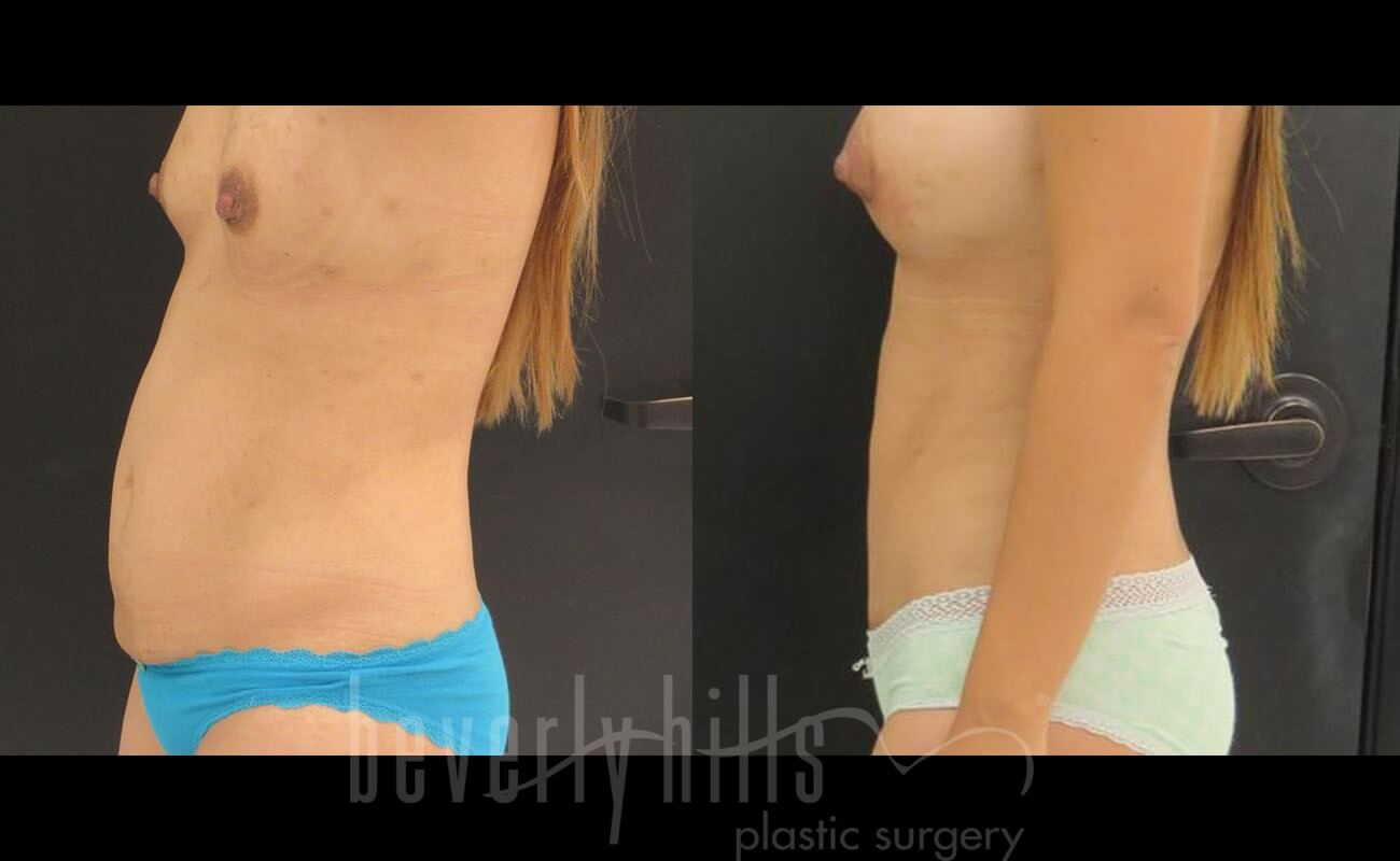 Tummy Tuck Patient 01 Before & After