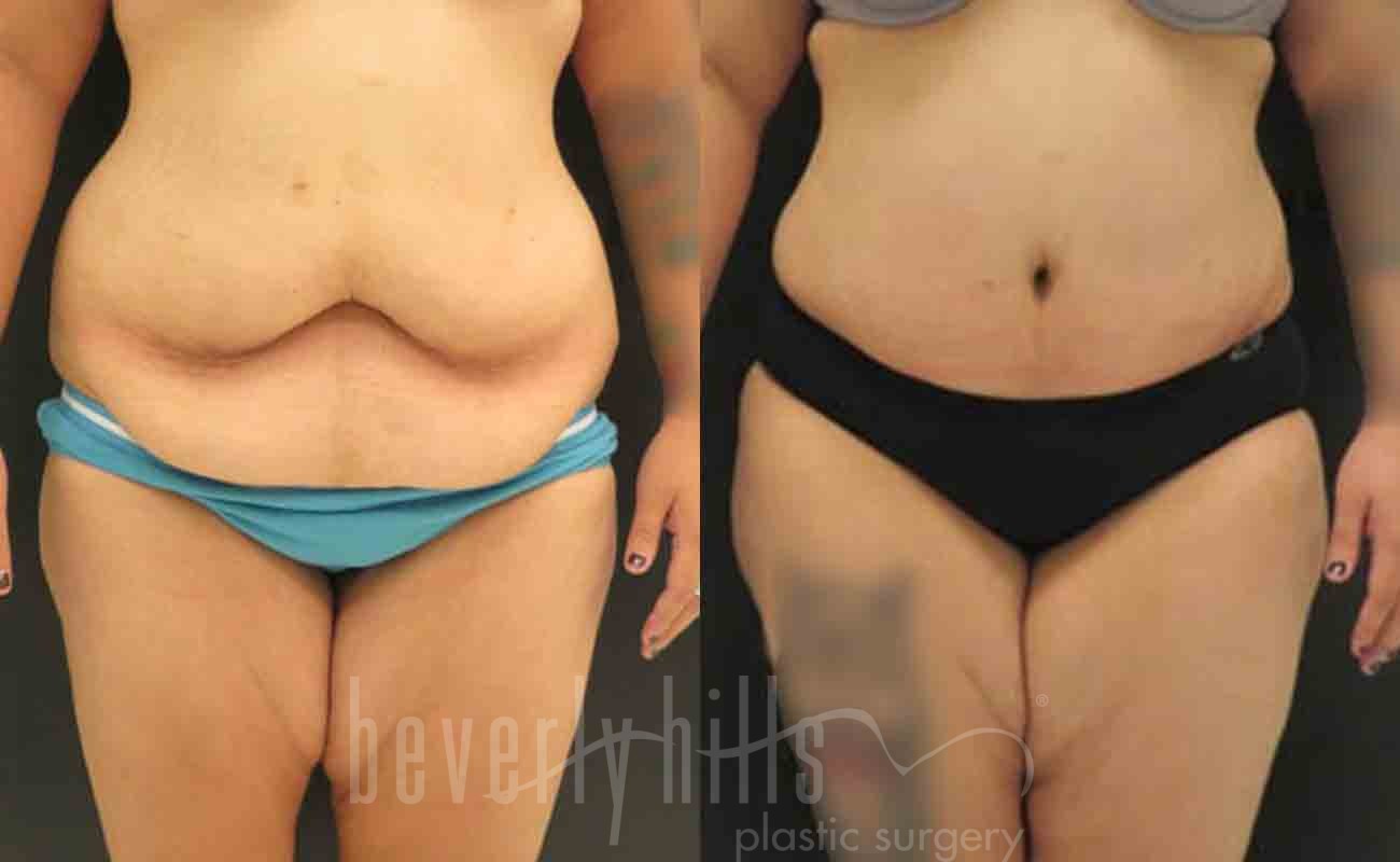 Tummy Tuck Patient 12 Before & After