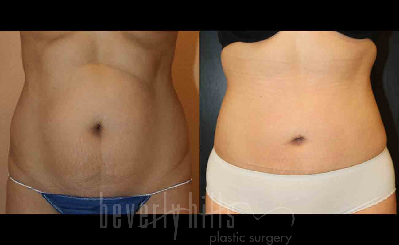 Tummy Tuck Patient 13 Before & After