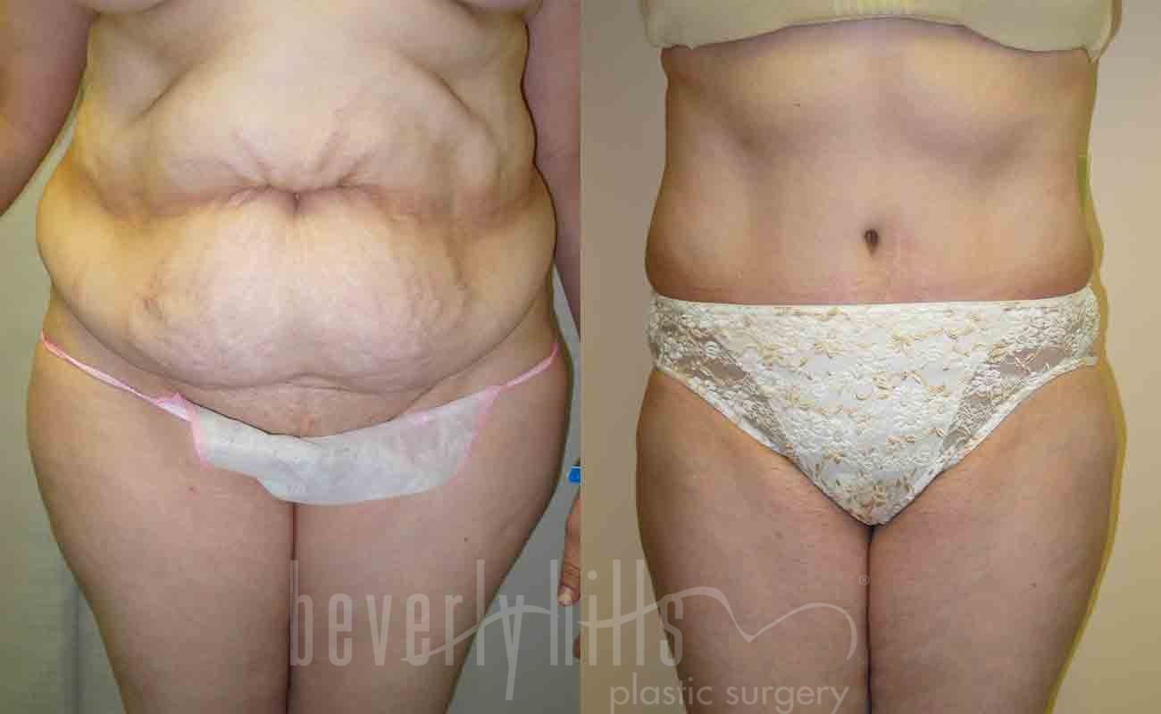 Tummy Tuck Patient 14 Before & After