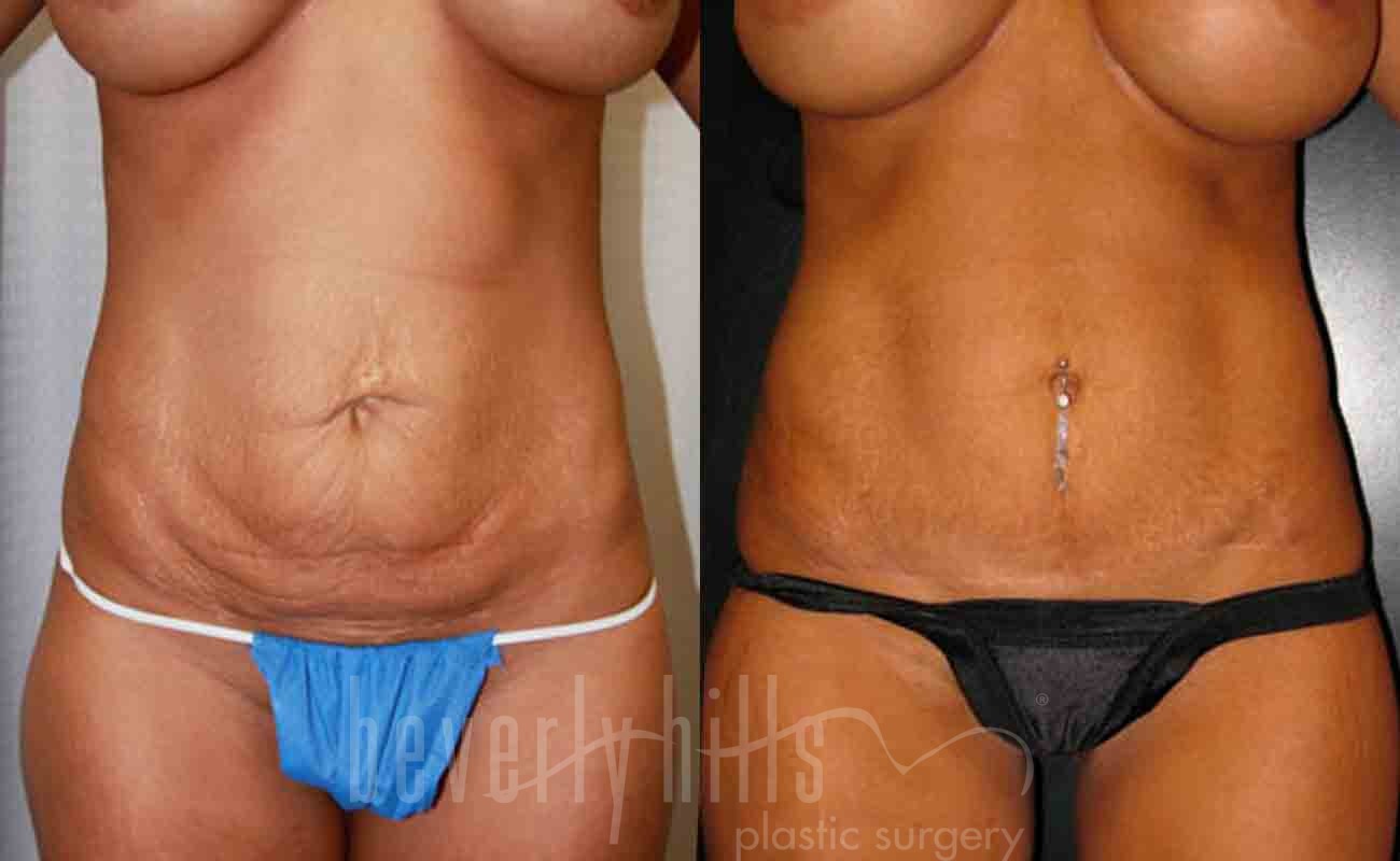 Tummy Tuck Patient 16 Before & After