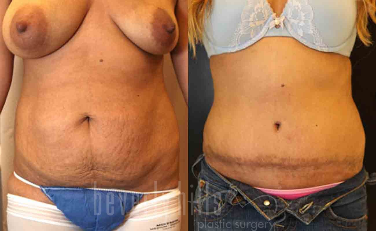 Tummy Tuck Patient 17 Before & After