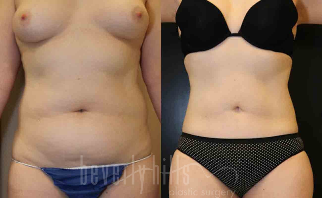 Tummy Tuck Patient 18 Before & After
