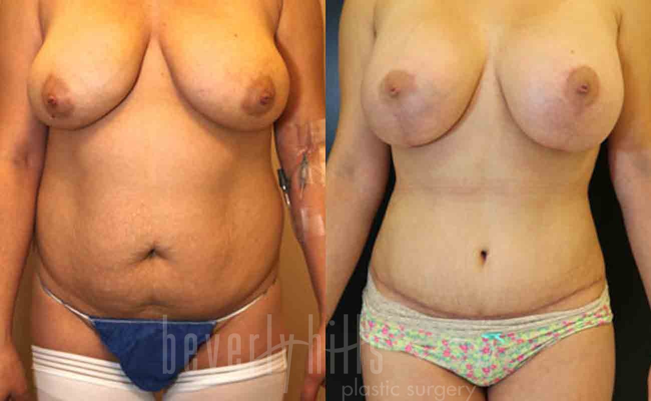 Tummy Tuck Patient 19 Before & After