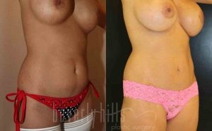 Tummy Tuck Patient 20 Before & After - Thumbnail