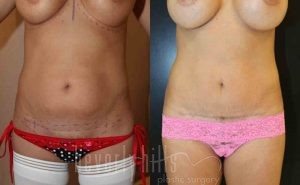 Tummy Tuck Patient 20 Before & After - Thumbnail
