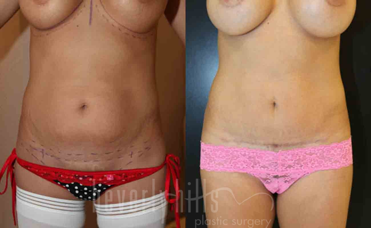 Tummy Tuck Patient 20 Before & After
