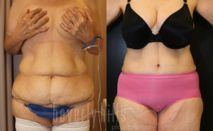 Tummy Tuck Patient 23 Before & After - Thumbnail