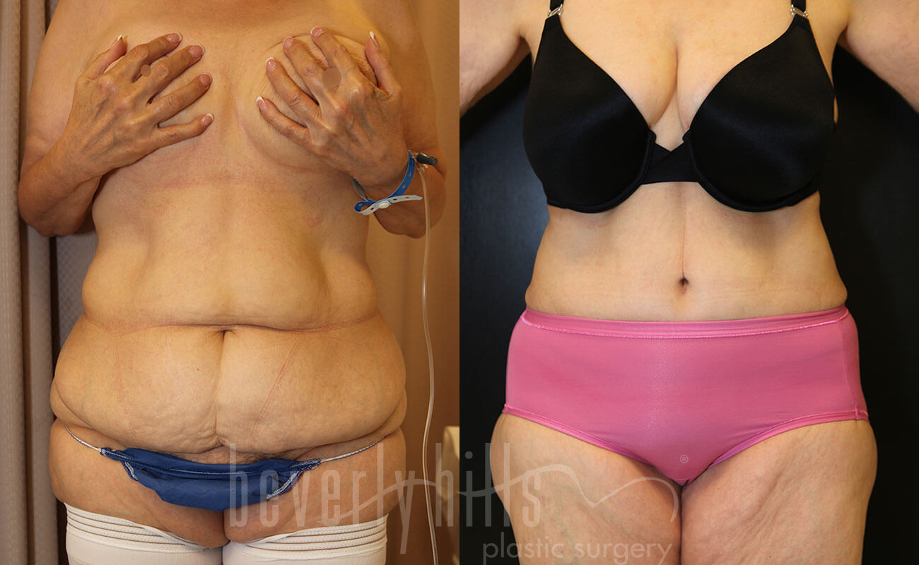 Tummy Tuck Patient 23 Before & After