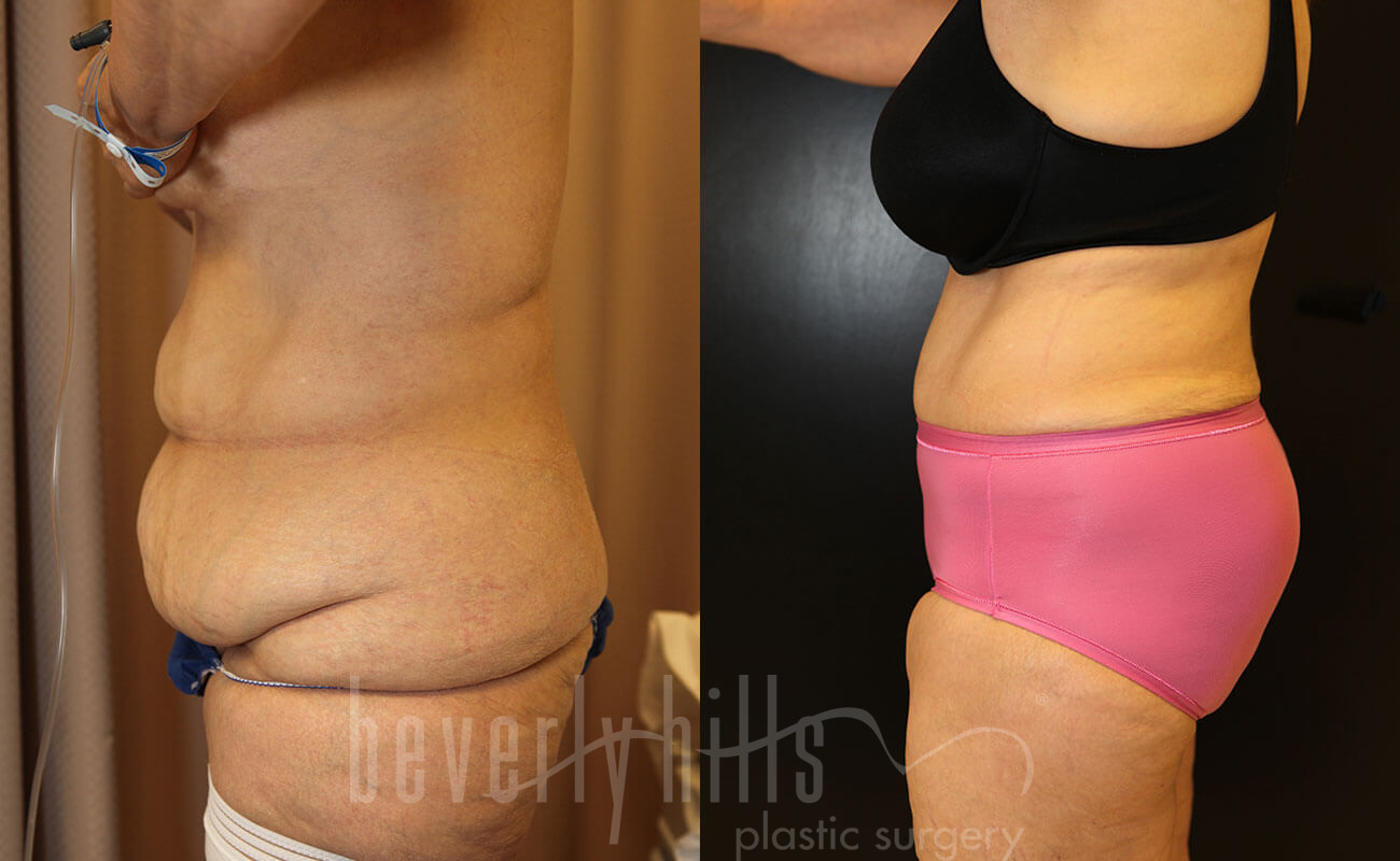Tummy Tuck Patient 23 Before & After