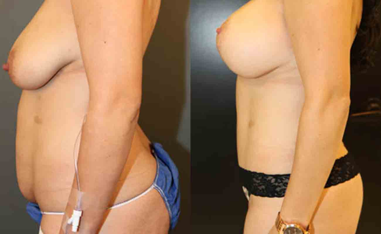 Tummy Tuck Patient 02 Before & After