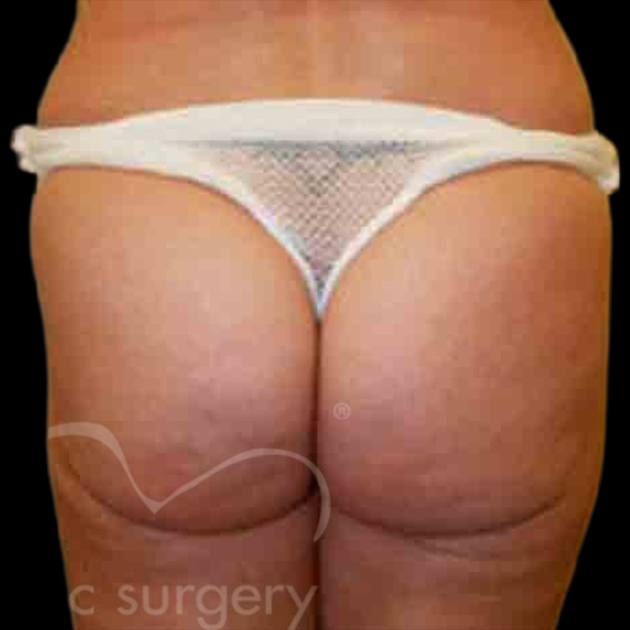 Case--5077 | After Body