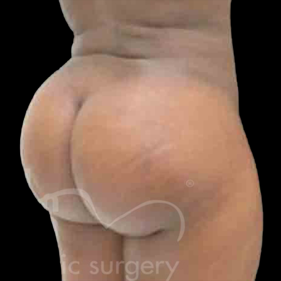 Case--9336 | After Body