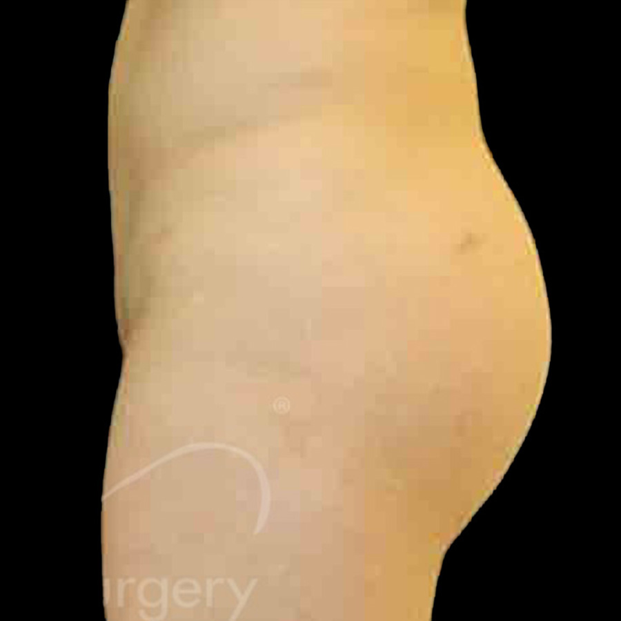 Case--1531 | After Brazilian Butt Lift