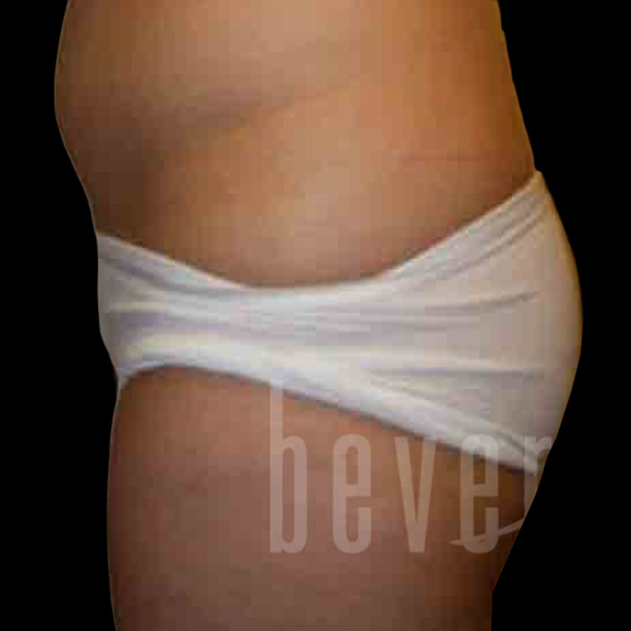 Case--1531 | Before Brazilian Butt Lift