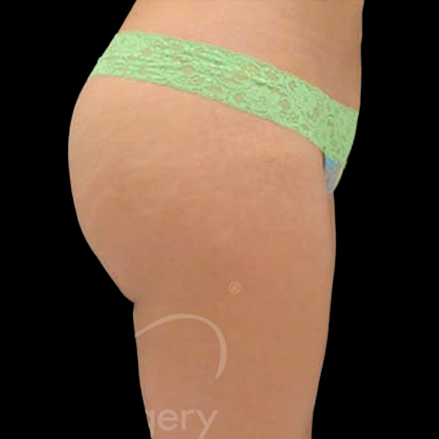 Case--3948 | After Brazilian Butt Lift