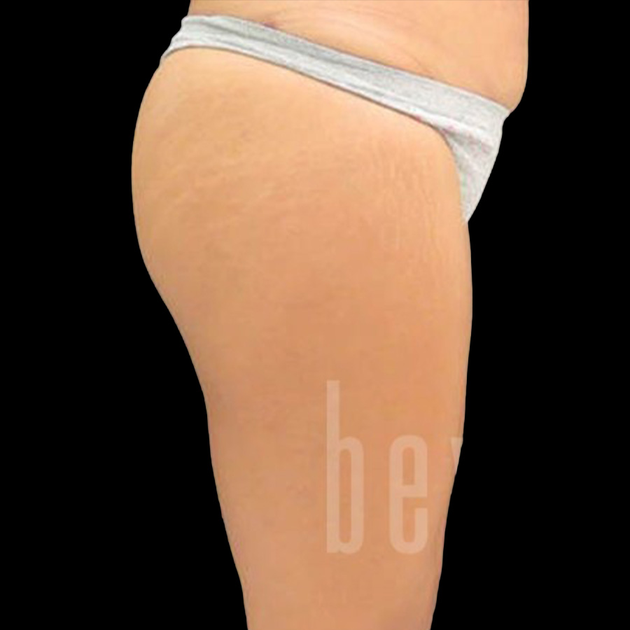 Case--3948 | Before Brazilian Butt Lift