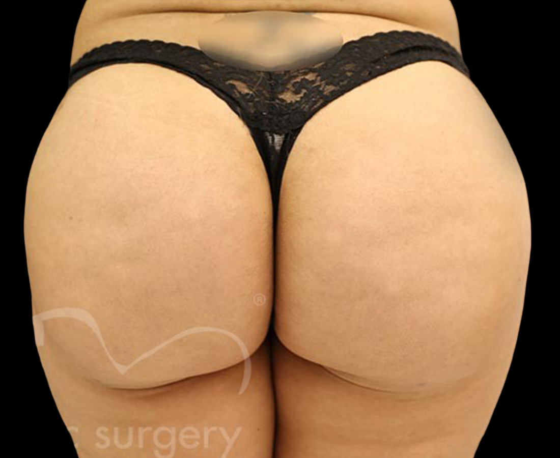 Case--6730 | After Brazilian Butt Lift
