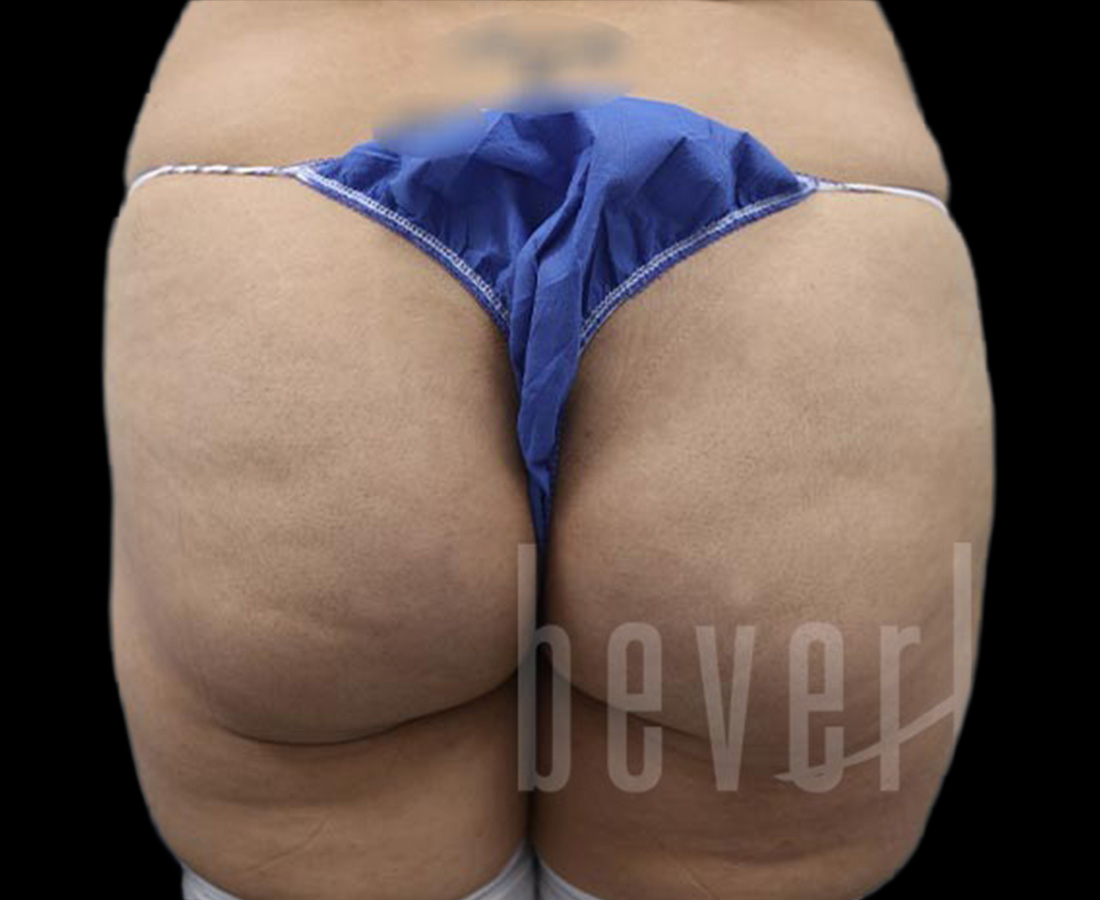 Case--6730 | Before Brazilian Butt Lift