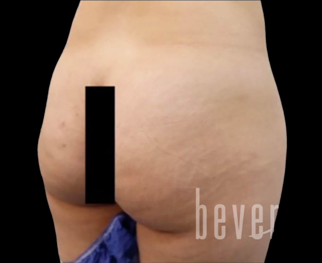 Case--6895 | Before Brazilian Butt Lift