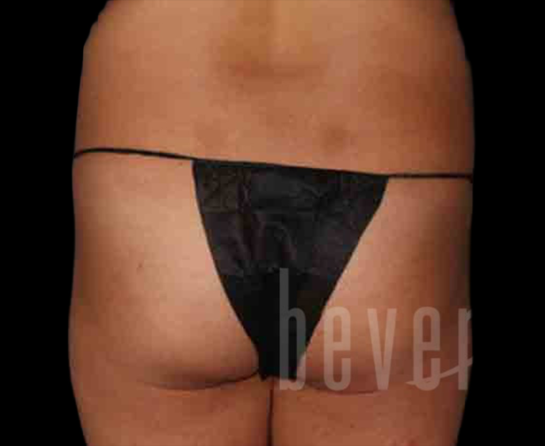 Case--4195 | Before Brazilian Butt Lift