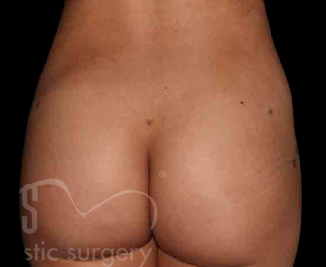 Case--7902 | After Brazilian Butt Lift