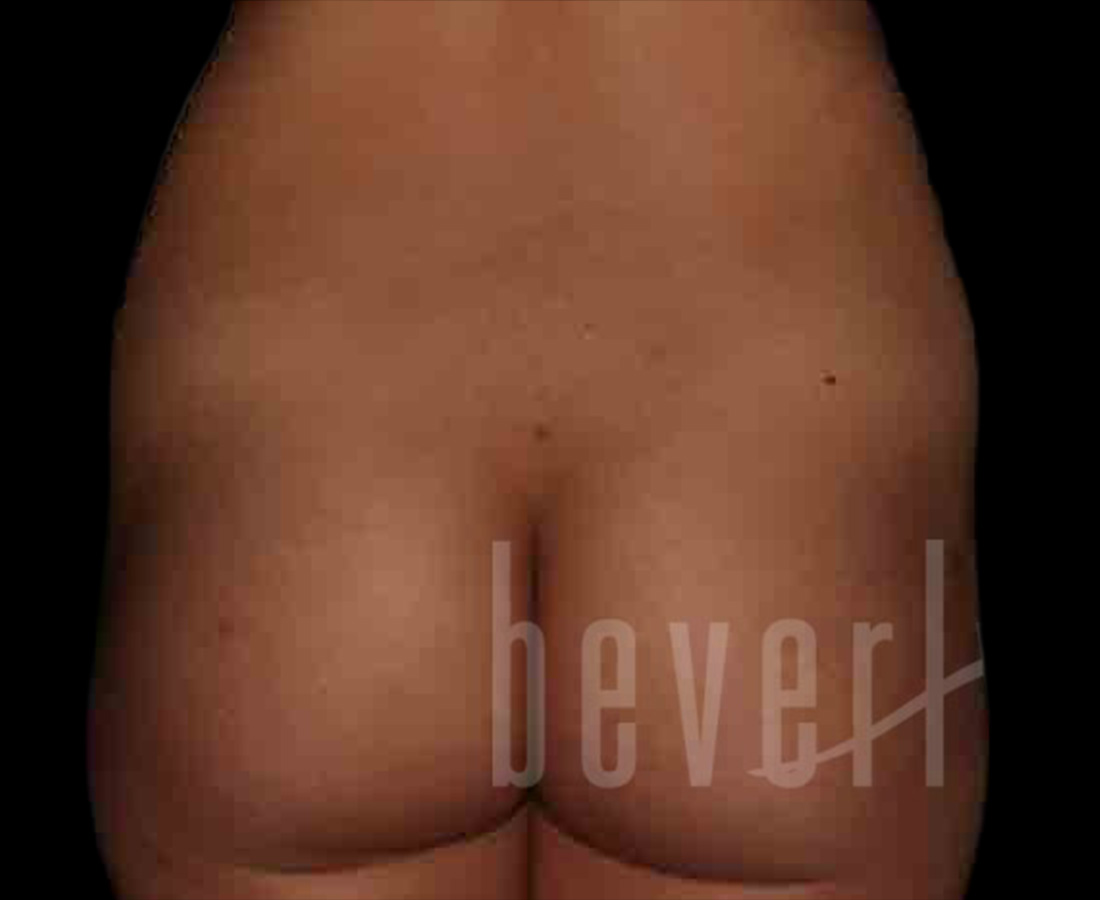 Case--7902 | Before Brazilian Butt Lift