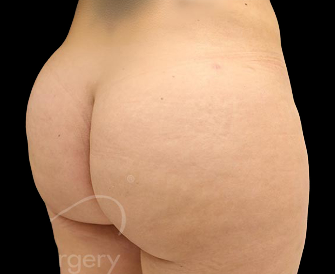 Case--1223 | After Brazilian Butt Lift 2