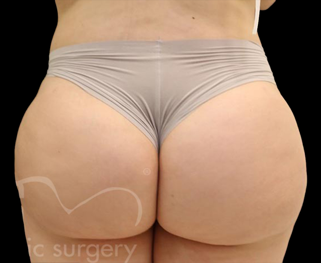 Case--1223 | After Brazilian Butt Lift
