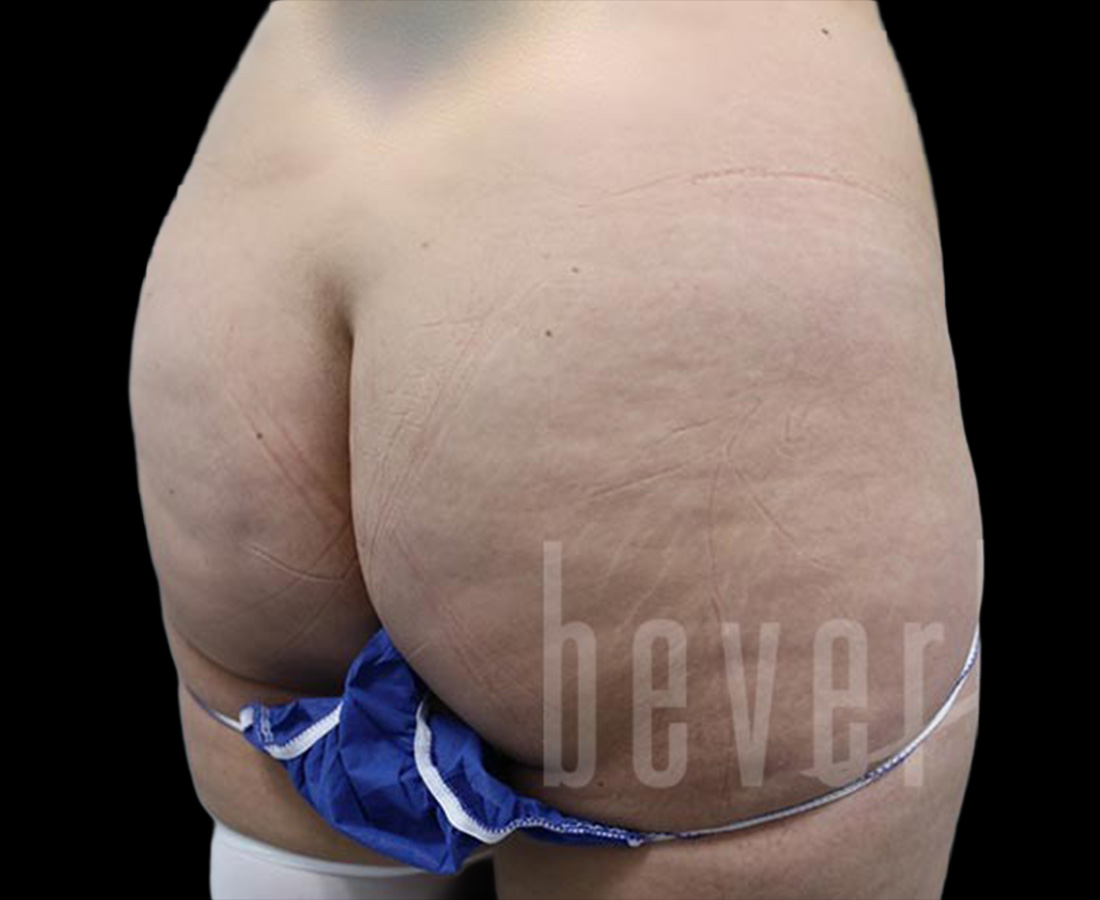 Case--1223 | Before Brazilian Butt Lift 2