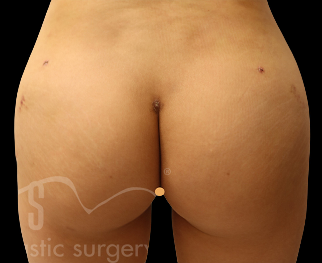 Case--1572 | After Brazilian Butt Lift
