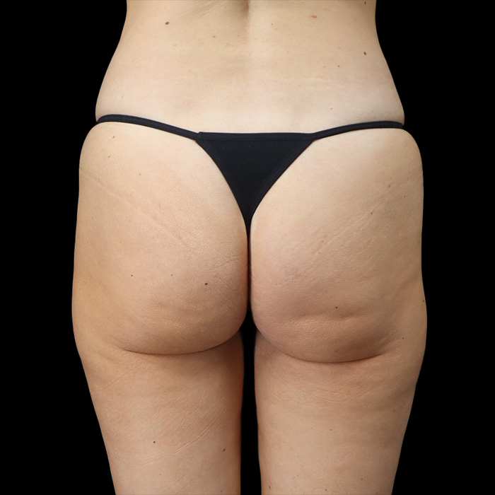 Case--9323 | Before Brazilian Butt Lift