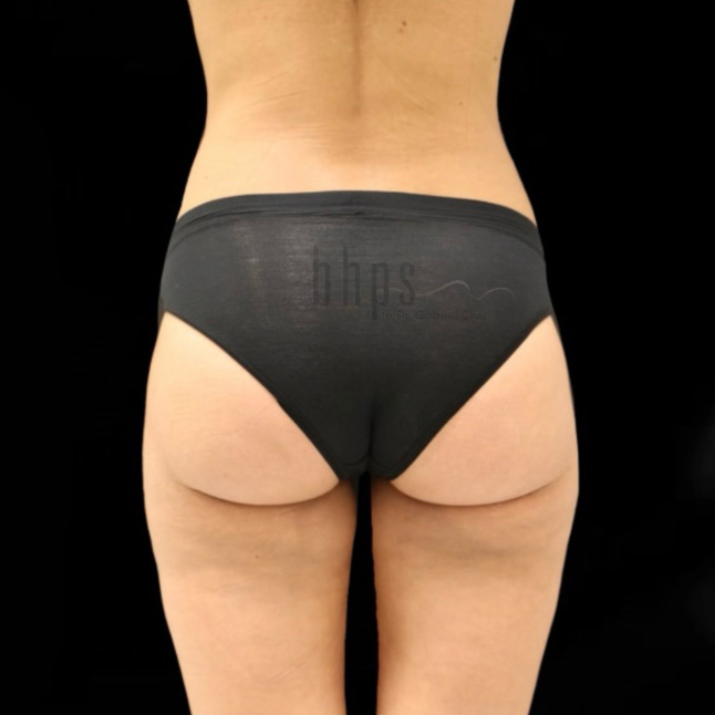 Brazilian Butt Lift Patient After - 1