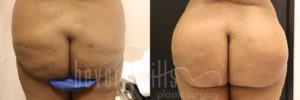 Brazilian Butt Lift Patient 22 Before & After - Thumbnail