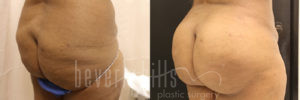 Brazilian Butt Lift Patient 22 Before & After - Thumbnail