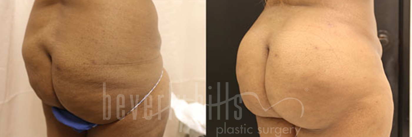 Brazilian Butt Lift Patient 22 Before & After