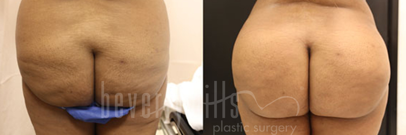 Brazilian Butt Lift Patient 22 Before & After