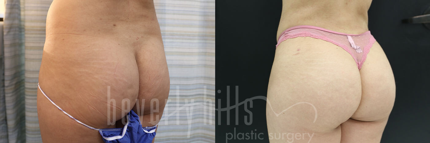 Brazilian Butt Lift Patient 23 Before & After